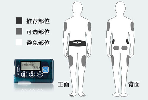 胰岛素泵针头埋置部位及注意事项