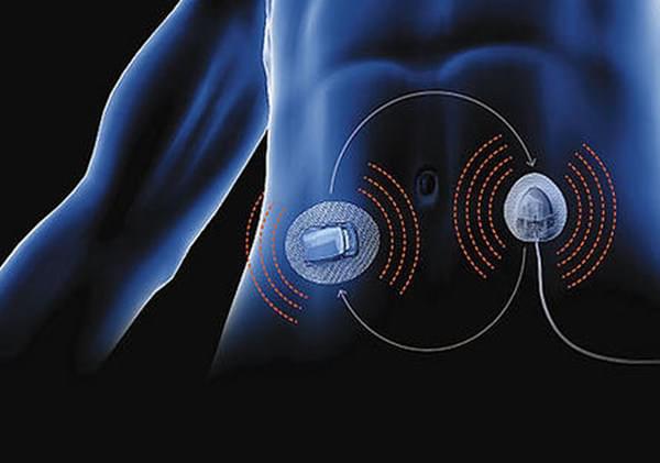 闭环式胰岛素泵