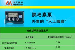 为什么会选择胰岛素泵强化治疗