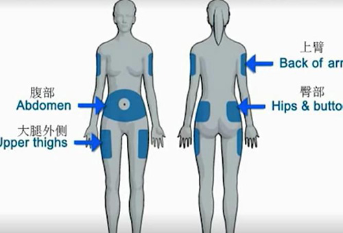 胰岛素泵植入部位