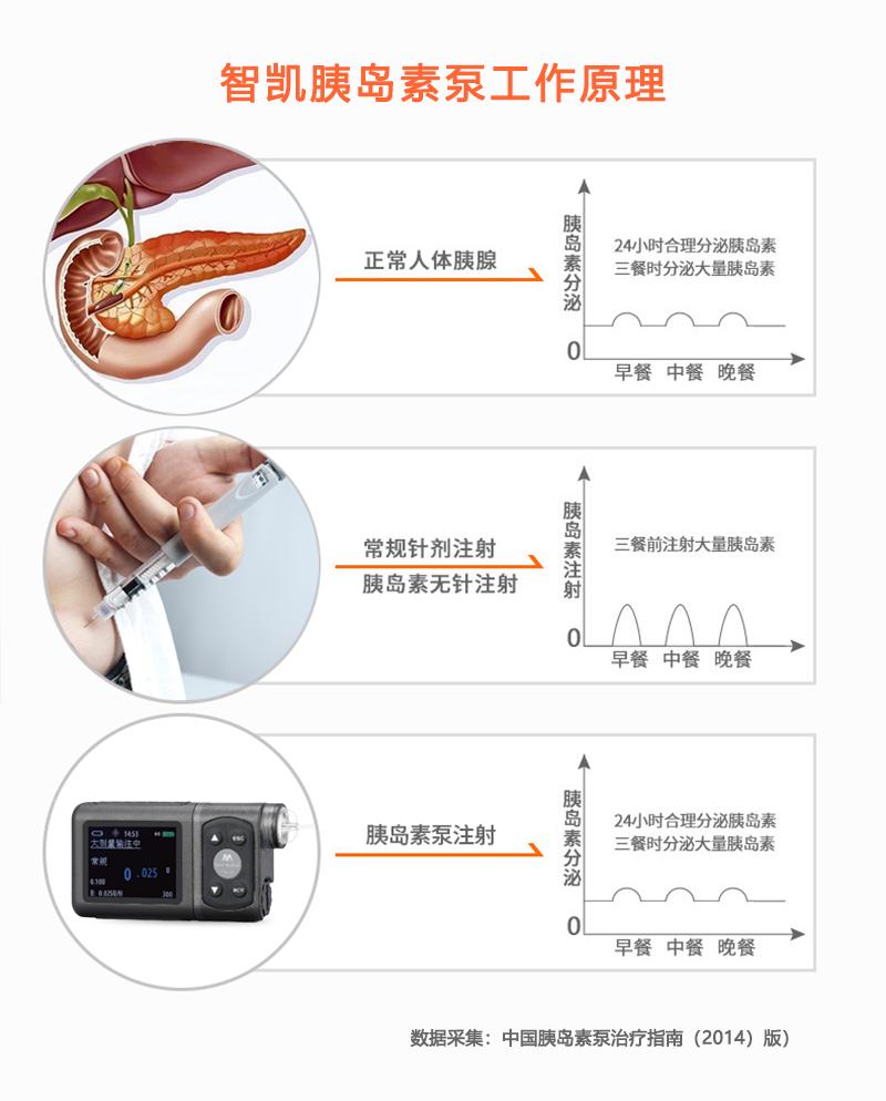 胰岛素泵的工作原理